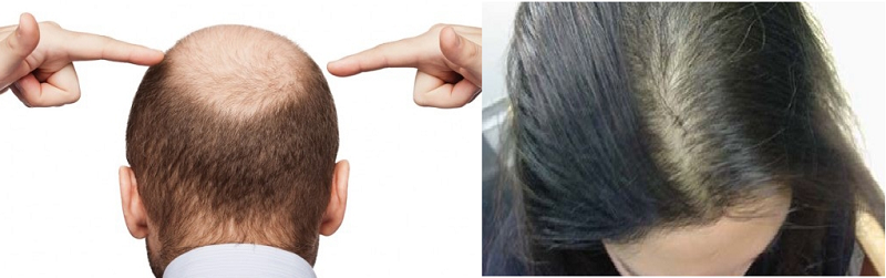 চুল পড়া রোধে করনীয়