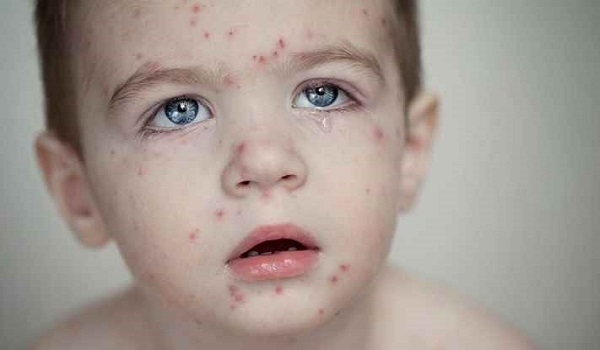 হাম ও হামের উপসর্গে ১১ জনের মৃত্যু